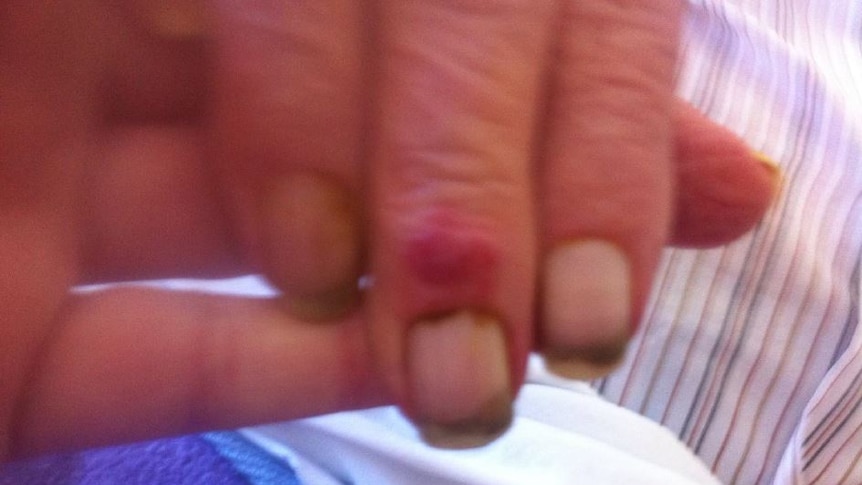 An elderly man's dirty and unclipped fingernails.