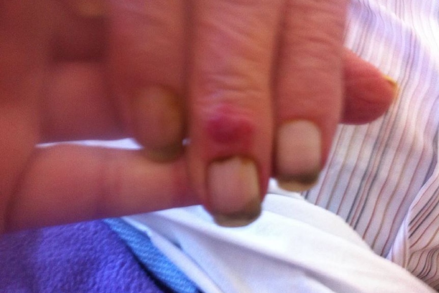 An elderly man's dirty and unclipped fingernails.