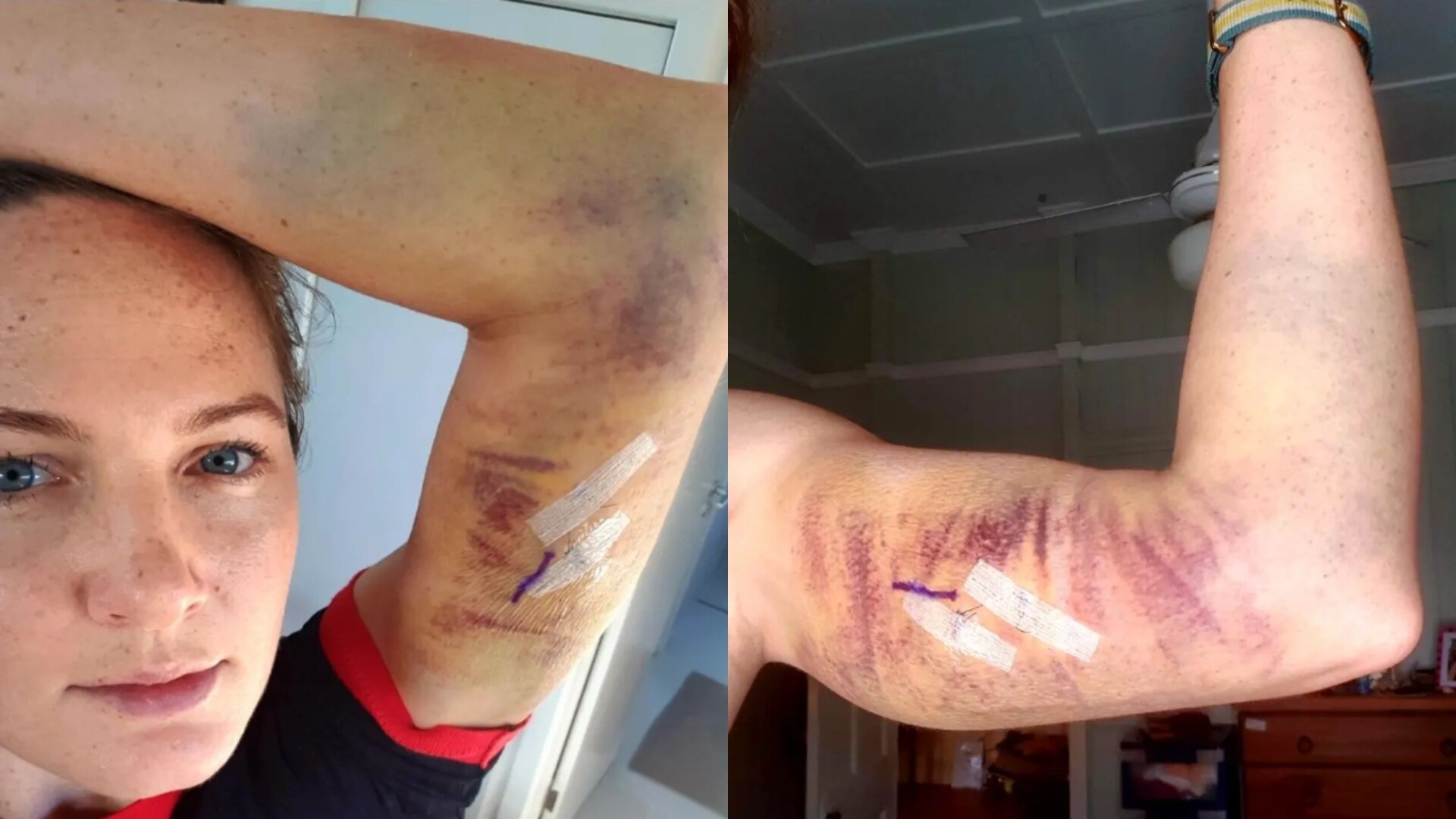 A split screen image showing Cate Campbell's extremely bruised arm