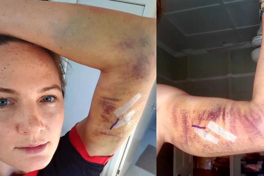A split screen image showing Cate Campbell's extremely bruised arm