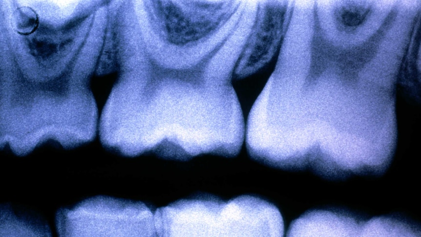 X-ray of child's teeth showing enamel