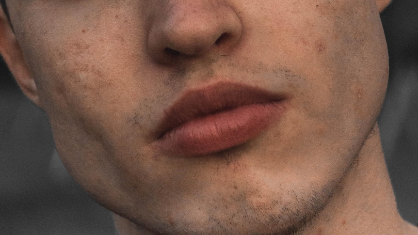 A portrait of a man with acne scarring on his cheeks.