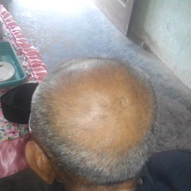 The back of an elderly man's head, with faint but still visible circular scars indented in the top of his head.