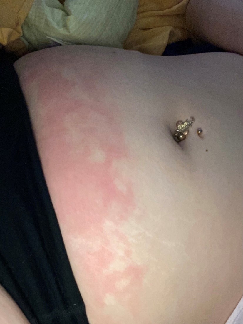 A womans stomach with heat burns. 