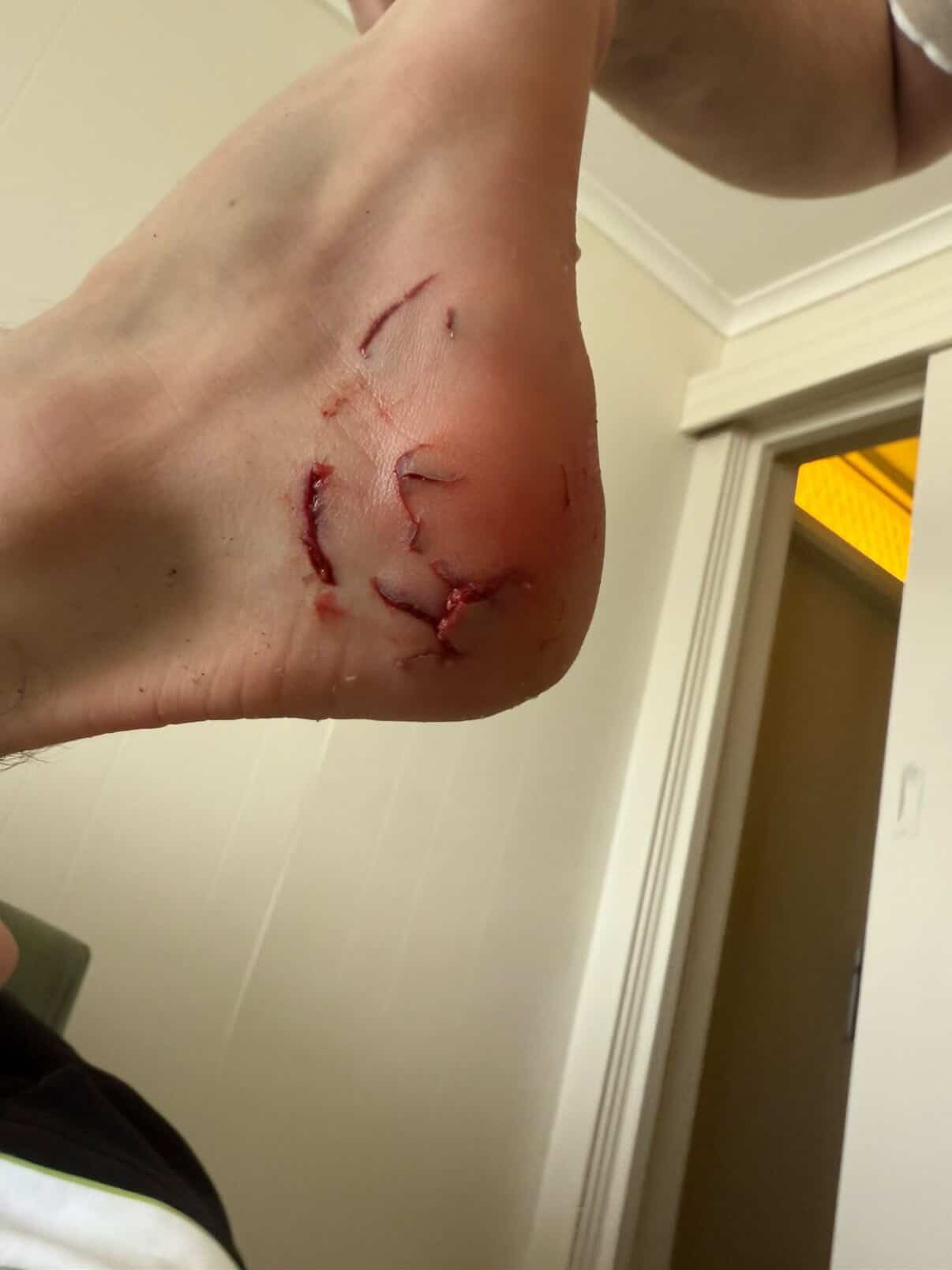 A close up photo of the heel of a foot with bite marks on it