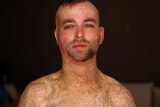 A man stands with his shirt off, showing bad burns scars across his chest and head.
