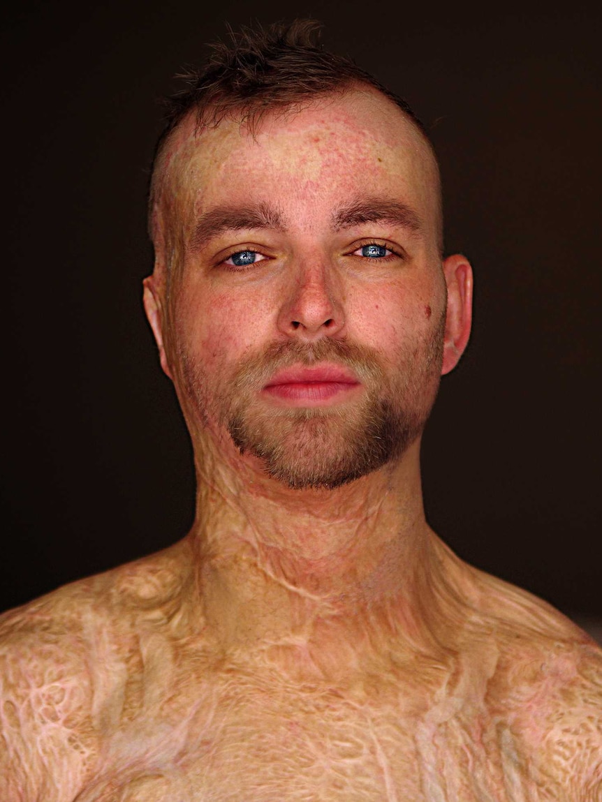 A man stands with his shirt off, showing bad burns scars across his chest and head.