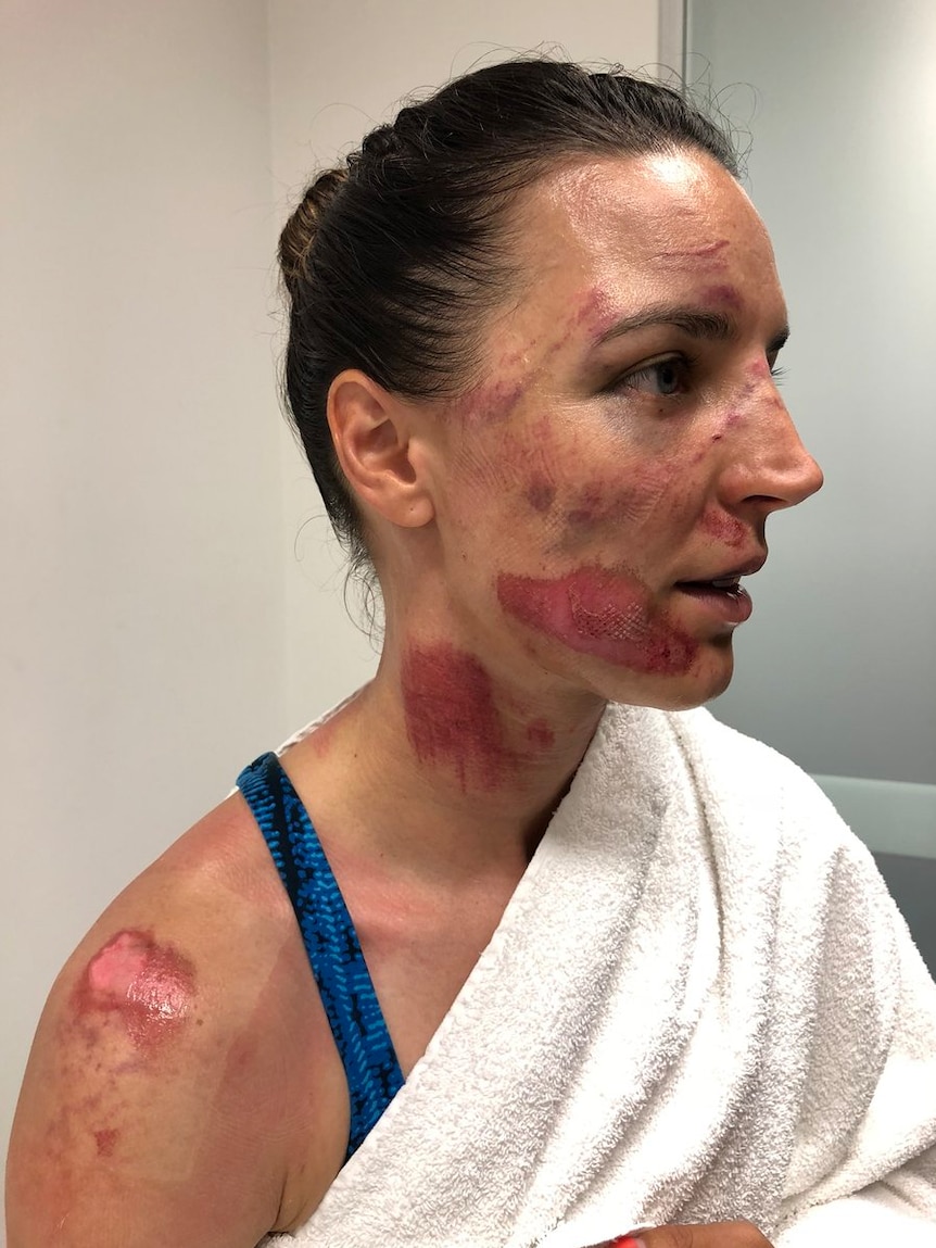 Rebecca Wiasak shows off the injuries she sustained during the Women's Tour Down Under in Adelaide
