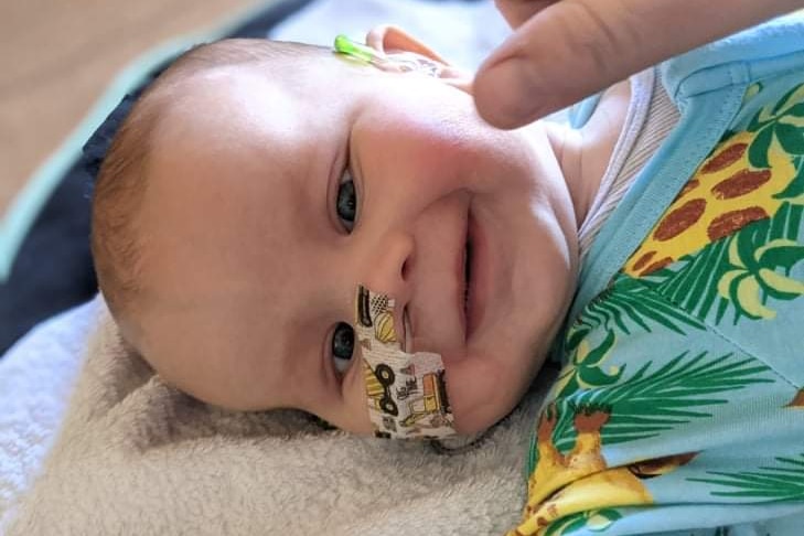 A smiling baby with a tube in his nose.