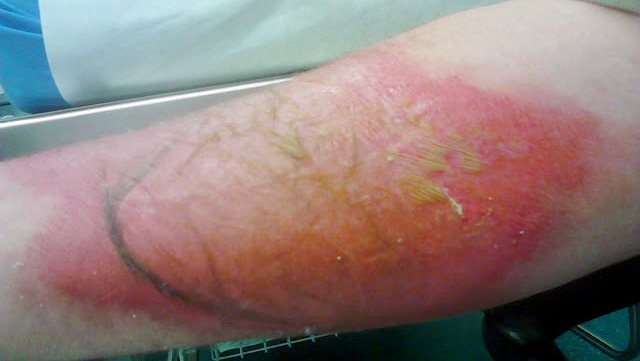 A n angry red burn on a person's arm in a hospital bed.