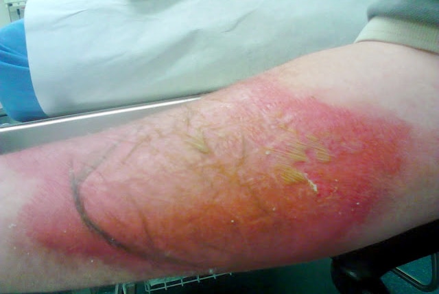 A n angry red burn on a person's arm in a hospital bed.