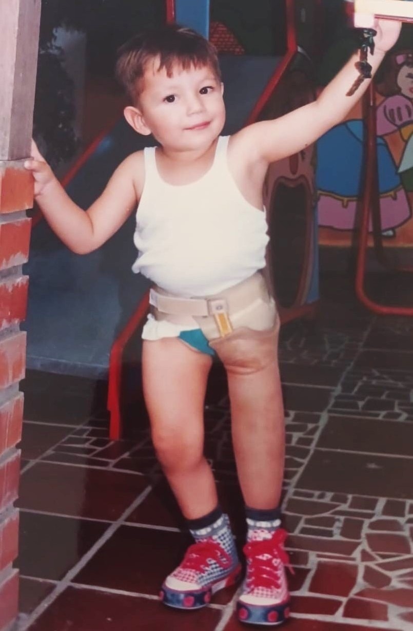 A boy standing wearing a prosthetic left leg