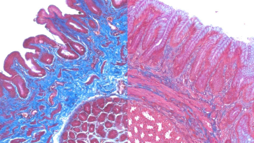 A blue and purple drawing like image demonstrated differences between stomach tissue