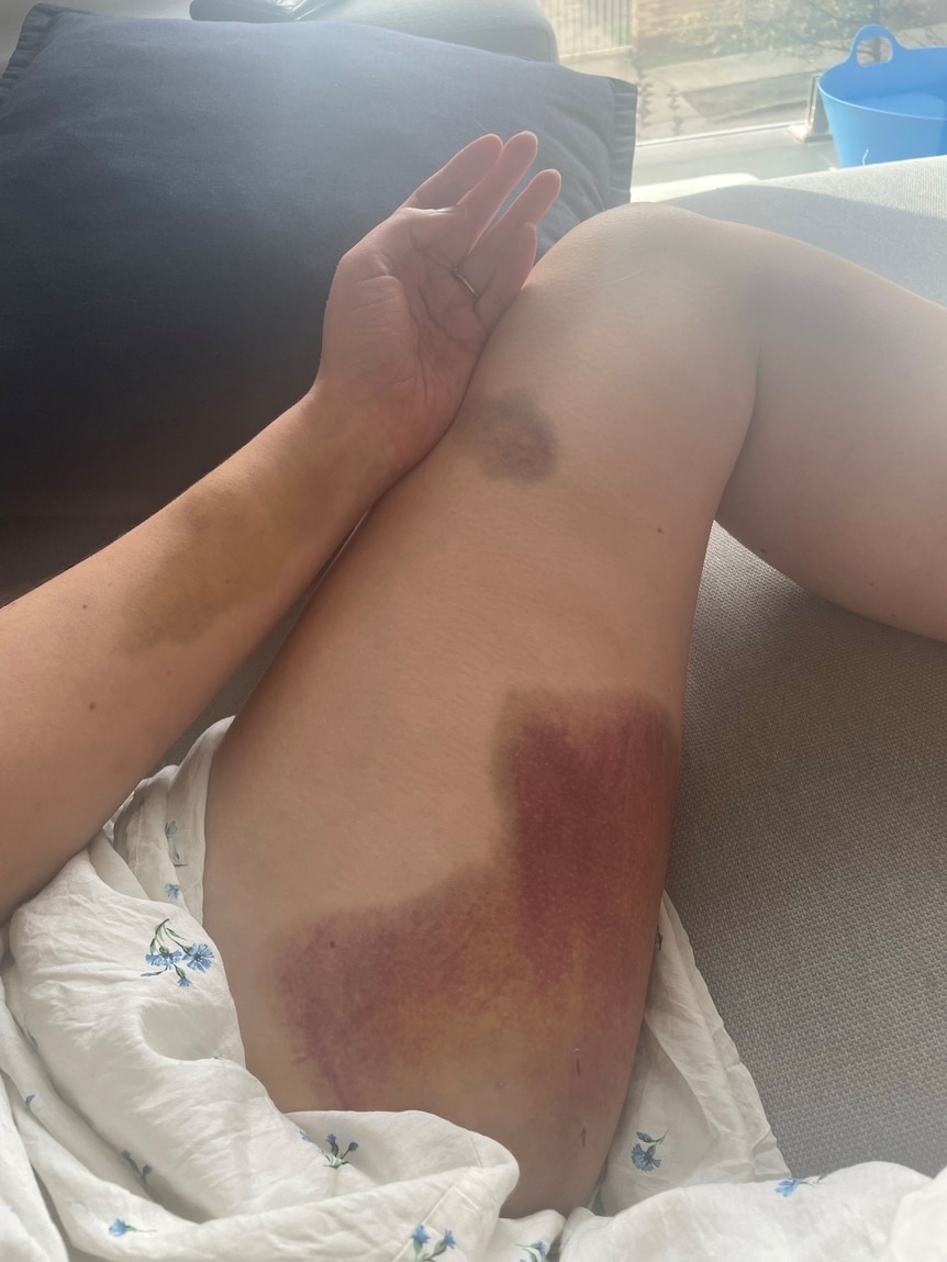 A woman's arm and leg with significant bruising