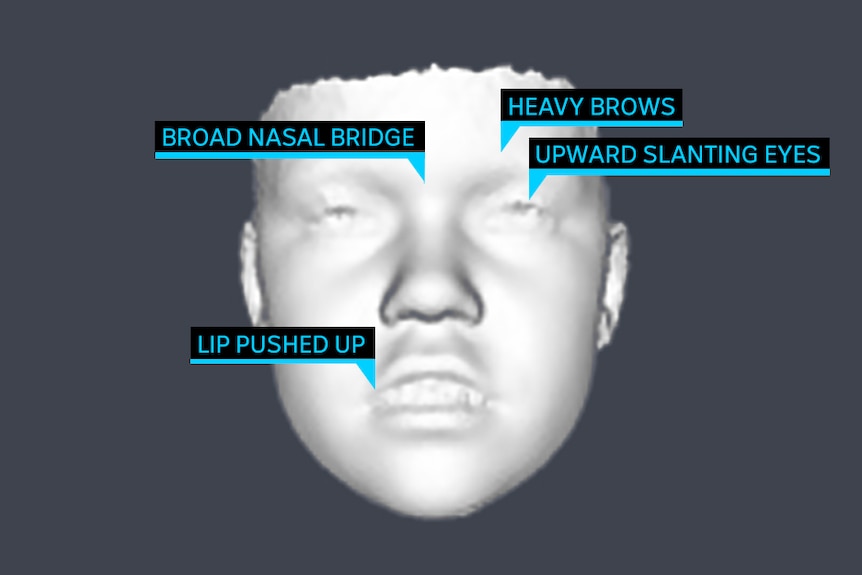 A graphic showing several facial features of someone with broad facial features.