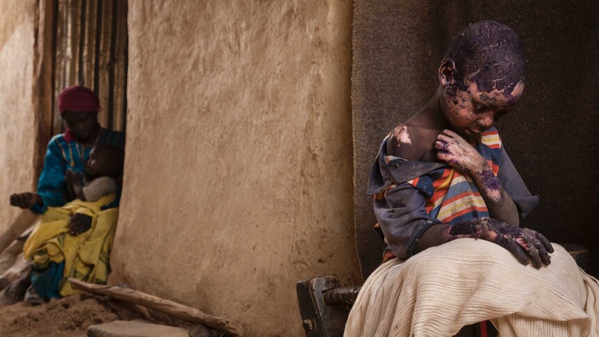 A young child, severely burned after a bomb explosion, sits in his family home in Sudan.