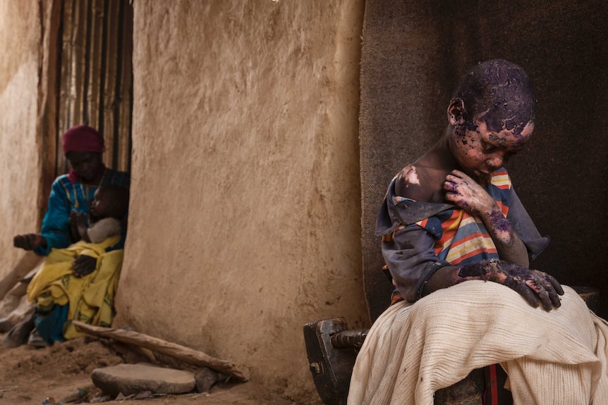 A young child, severely burned after a bomb explosion, sits in his family home in Sudan.