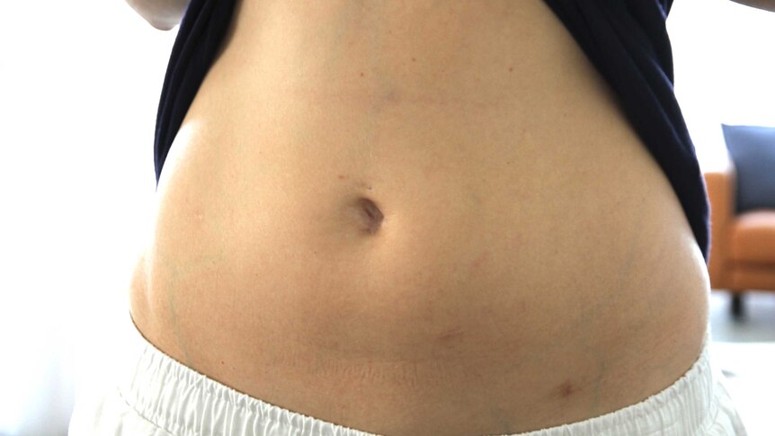 A woman's stomach with small scars on her abdomen from laparoscopy surgery