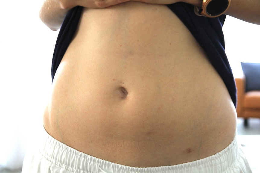 A woman's stomach with small scars on her abdomen from laparoscopy surgery