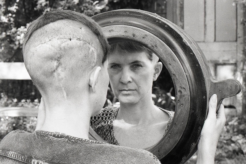 A black and white photo of a woman with surgical scars on her shaved head