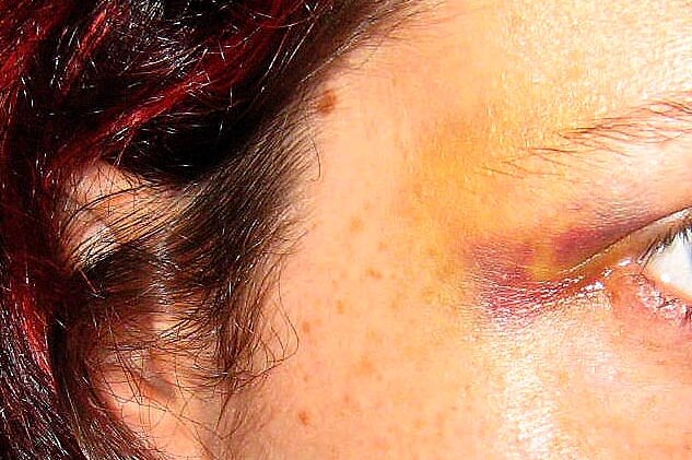 Bruised eye