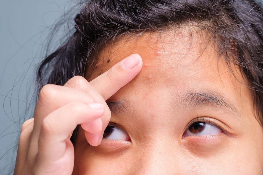 young girl's forehead with pimples