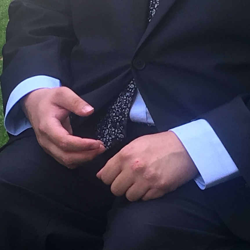 A close-up of Jordon Steele-John's hands on his lap shows there are scratches on his knuckles.