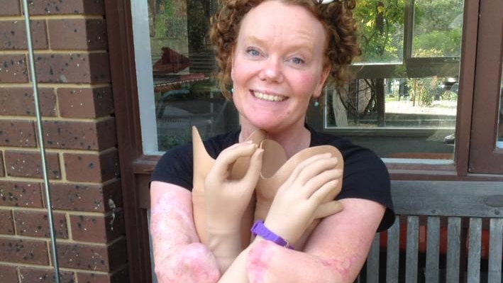 A women is smiling at the camera cradling her four prosthetic limbs in lap.