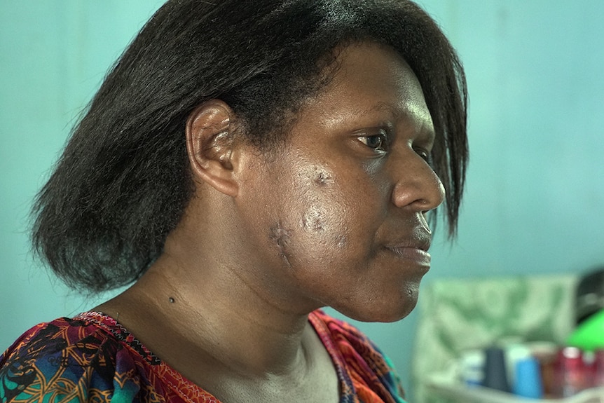A profile of Velma Ninjipa that shows her scars.