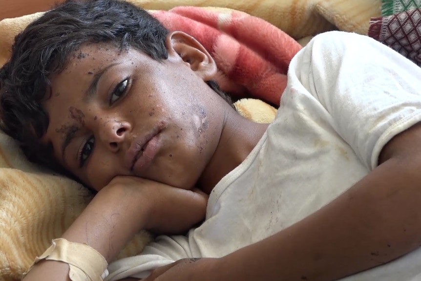 young boy lying in hospital bed with wounds that are healing.