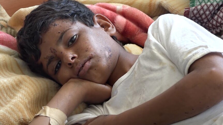 young boy lying in hospital bed with wounds that are healing.