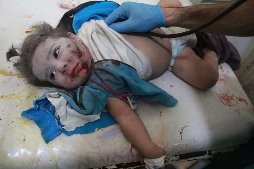 A Syrian girl is treated after Russian airstrikes