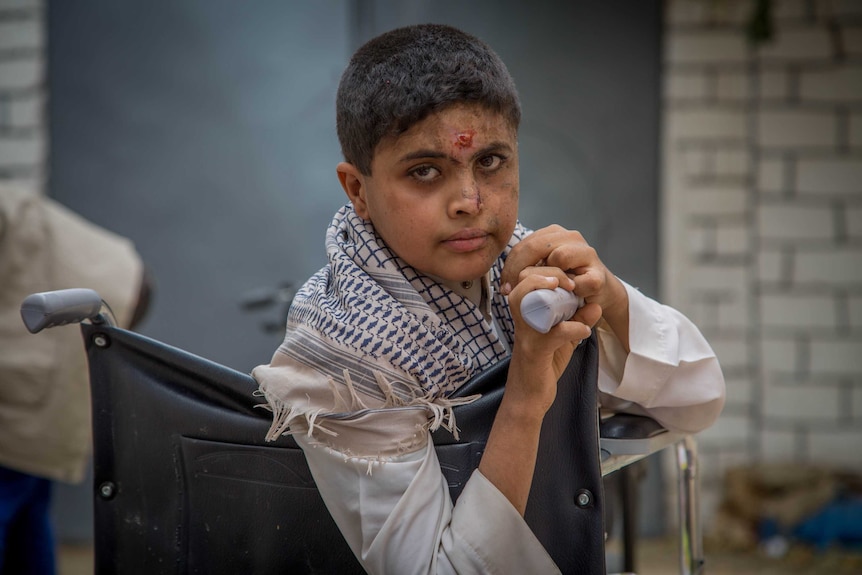 A young boy with wounds on his face in a wheelchair