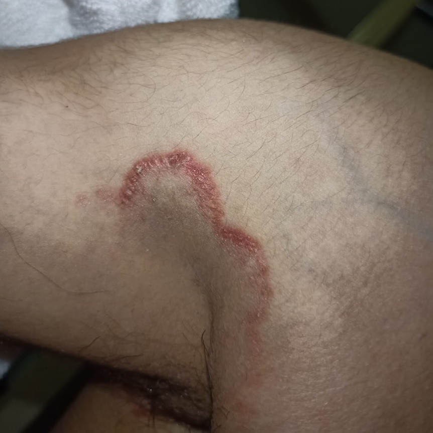 Vision of psoriasis on Amin's armpit.