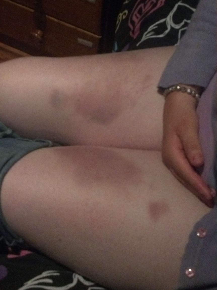 Bruised legs of group home resident Samantha Cox