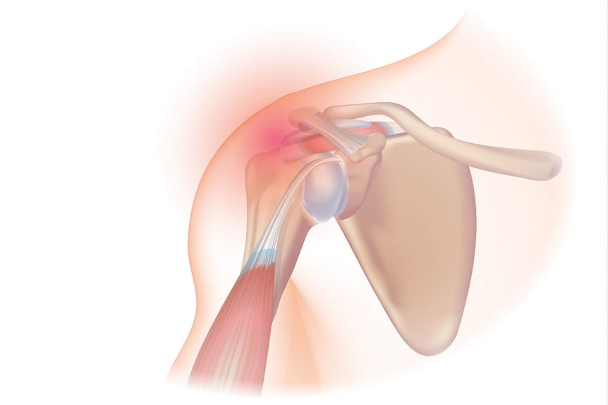 A graphic depicting rotator cuff muscles