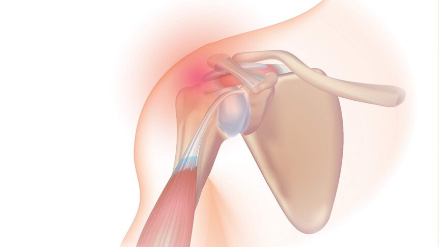 A graphic depicting rotator cuff muscles