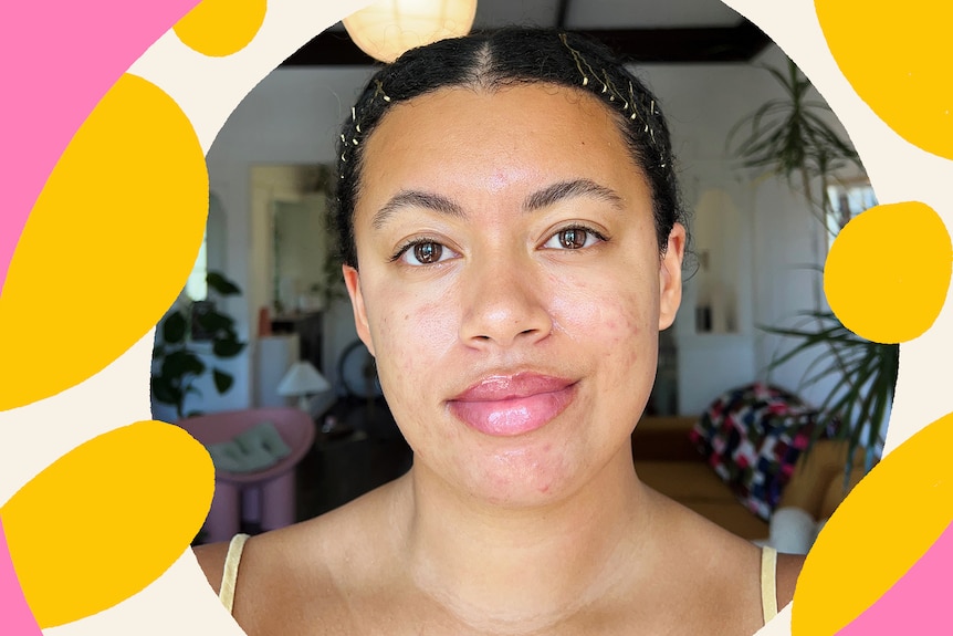Yasmin is seen in a selfie showing her skin with hyperpigmentation. Pink, yellow and cream blobs have been edited in.