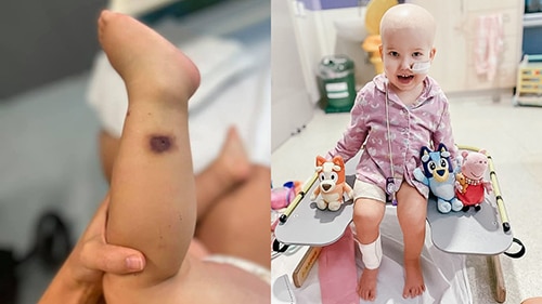 'It's more deadly than your cancer': How a common fungus almost killed a two-year-old leukaemia patient 