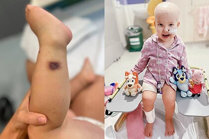 a composite image of a young girl and leg infection