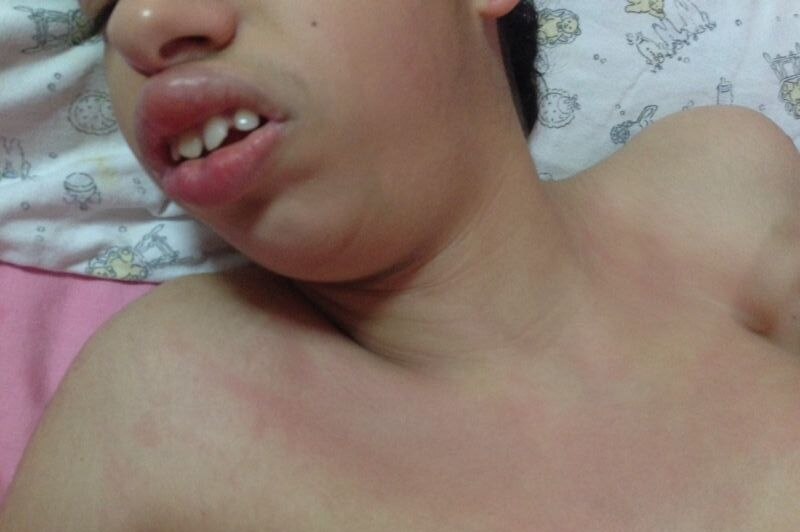 The rash on Ayat's body following the alleged neglect