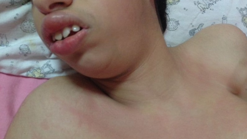 The rash on Ayat's body following the alleged neglect