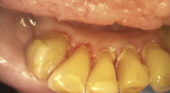 Discoloured yellow teeth inside a mouth