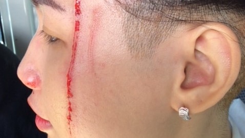 A girl has a large cut going down her face