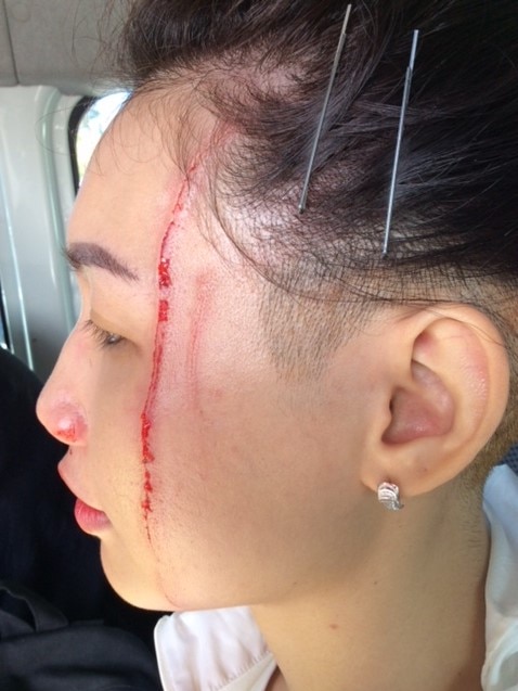 A girl has a large cut going down her face