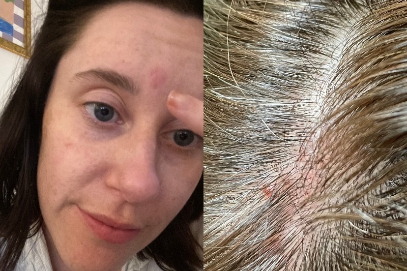 A composite image of a person's experience with shingles on their face and scalp.