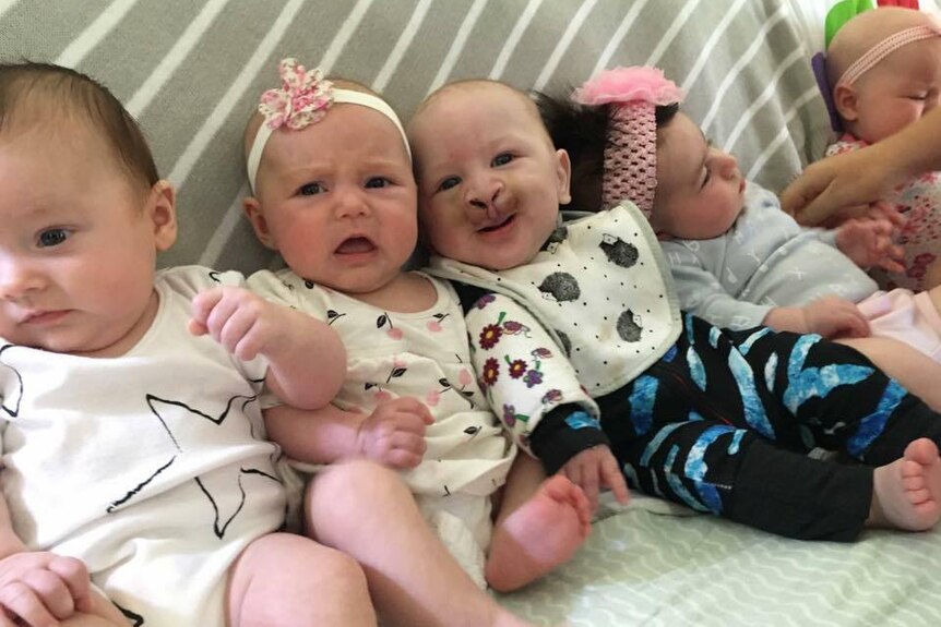 Charlie Halliday (centre), who was born with a cleft palate.