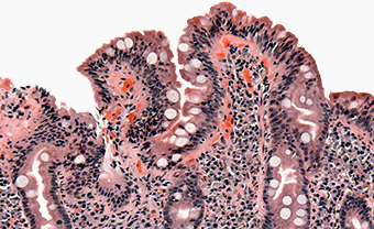 Coeliac disease