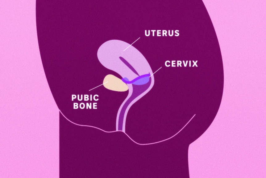 Graphic showing a uterus, cervix, pubic bone, and an inserted diaphragm cupping the cervix opening.