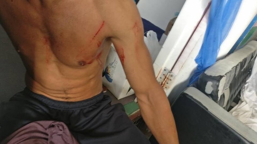 A refugee on Manus Island, who says his injuries were caused by police.